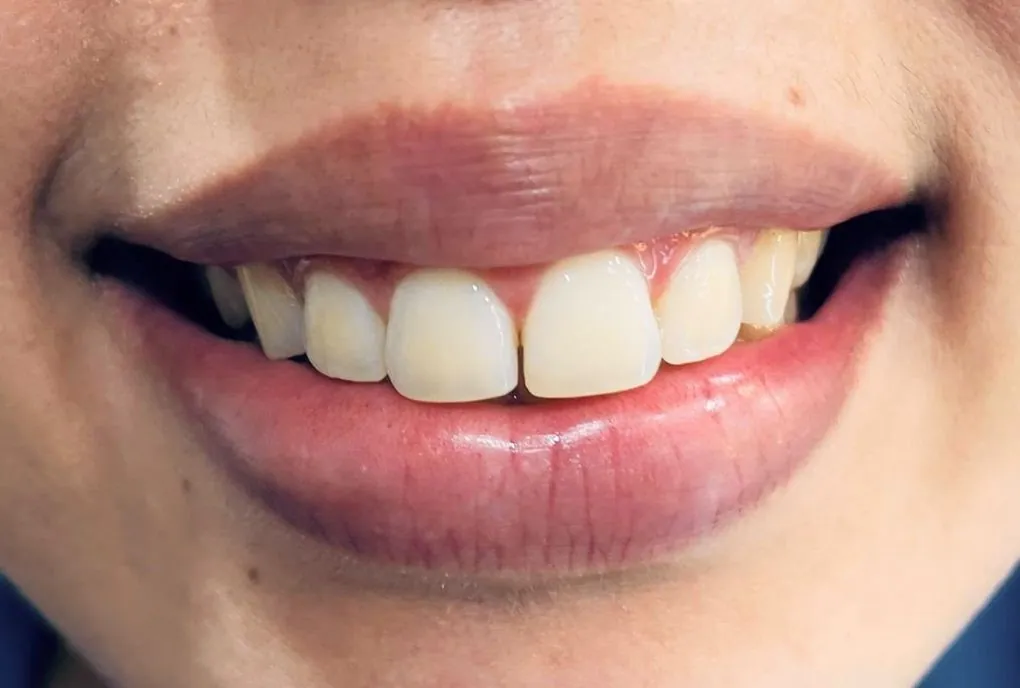 Antes: o mesmo sorriso, antes do tratamento
