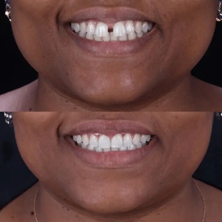 Antes e depois de fechamento de diastema, caso real de paciente da Potenza Odontologia
