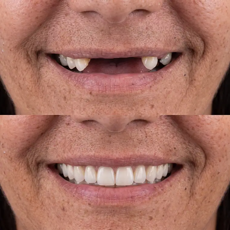 Antes e depois de prótese dentária, caso real de paciente da Potenza Odontologia